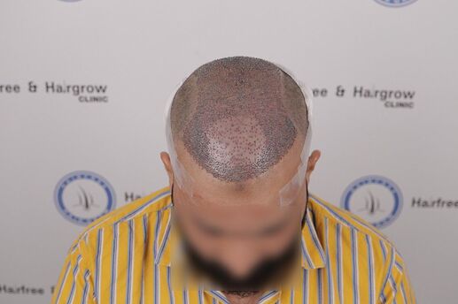 after hair transplant