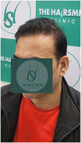 After Hair Transplant Result (6) in India  form The Hairsmith Hair Transplant Clinic