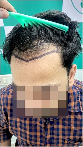 Before Hair Transplant HS 827- The Hairsmith Clinic Delhi India - 4