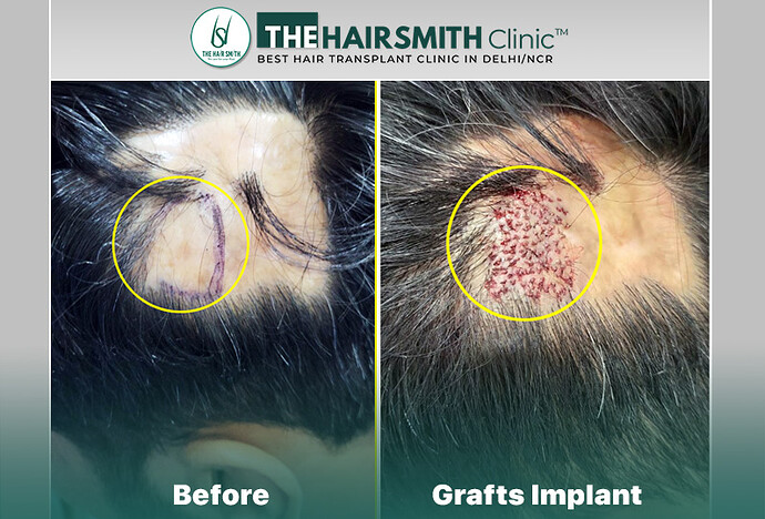 Grafts Implant - Hairsmith Hair Transplant