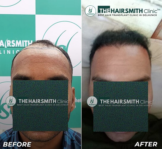 The Hairsmith Clinic Hair Transplant Result - After 06 Months Update