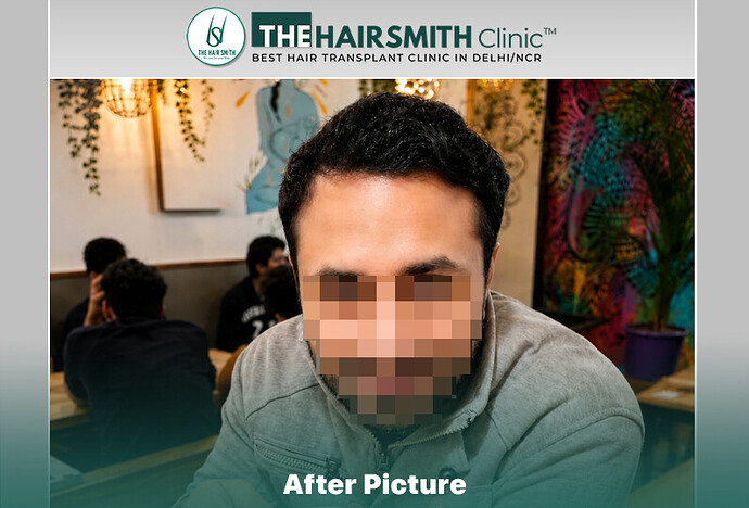 after hair transplant result - the hairsmith clinic delhi india #HairTransplant #URFUEHairTransplant