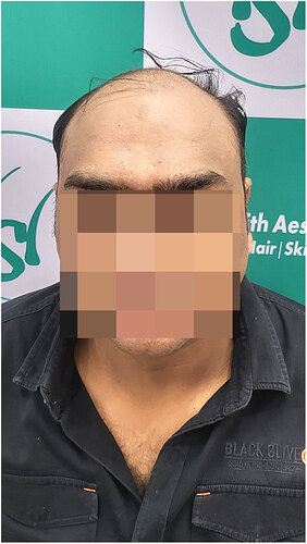 Before Hair Transplant HS 824- The Hairsmith Clinic Delhi India (1)