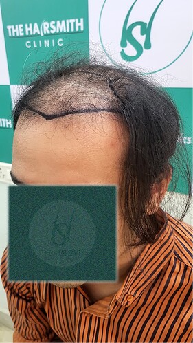 Patient Norwood stages 7 - Before  Picture 4 - The Hairsmith Hair Transplant Clinic