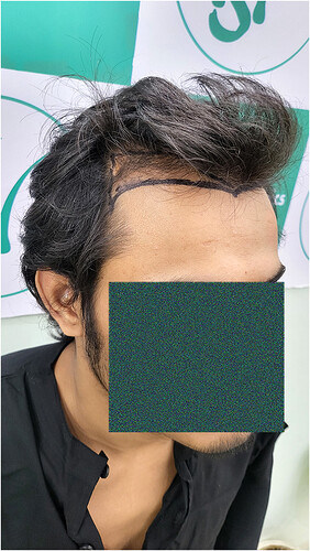 Patient Norwood stages 2 - Before  Picture 3 - The Hairsmith Hair Transplant Clinic