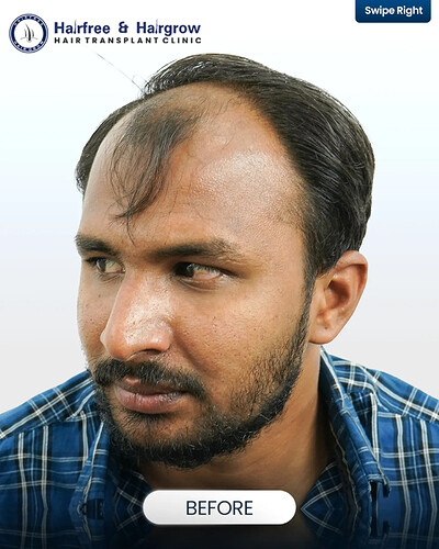 8 Years After Hair Transplant- Still Natural. A hair transplant is not just about immediate res (3)