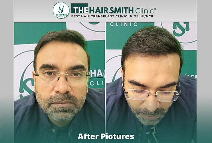 after hair transplant - the hairsmith clinic delhi india #hairtransplant #thehairsmithclinic #urfuehair transplant
