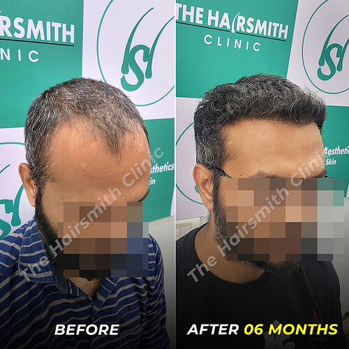 Hair Tarnsplant Befoe and After Result - photo 4 - The Hairsmith Clinic