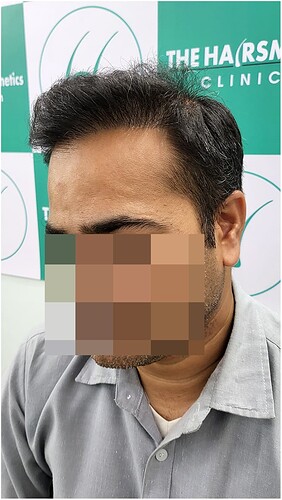 After 8 months hair transplant result - 3 the hairsmith clinic