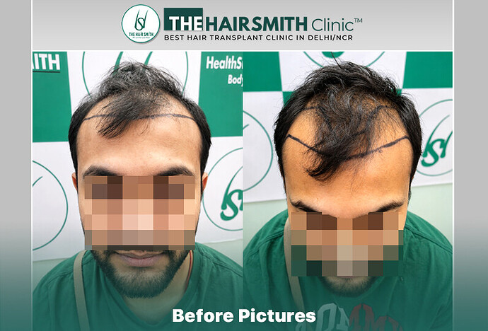 Before Hair Transplant HS 842- The Hairsmith Clinic Delhi India - #hairtransplant