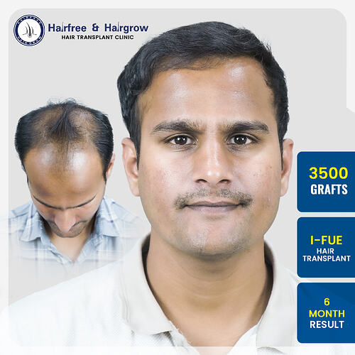pawan-jugulkar-3500-grafts-i-fue-hair-transplant-6-month-result-pune.jpg