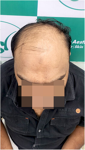 Before Hair Transplant HS 824- The Hairsmith Clinic Delhi India (3)