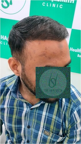 After Hair Transplant Result (3) in India  form The Hairsmith Hair Transplant Clinic
