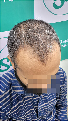 Before Hair Transplant - Norwood Stage 3 - photo 4- The Hairsmith Clinic