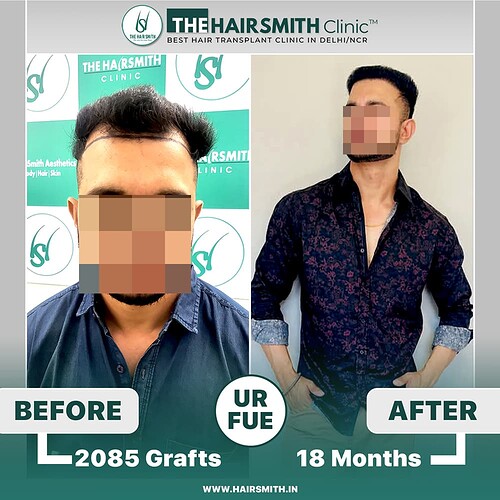 the hairsmith hair transplant result - after 18 months - update
