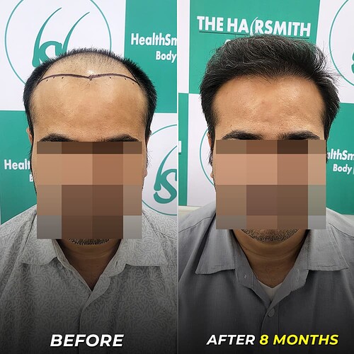 best hair transplant after 8 months at the hairsmith clinic - 1