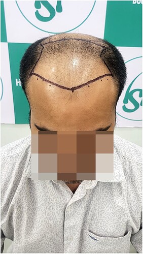 Before Hair Transplant HS 814 - The Hairsmith Clinic Delhi India - 2