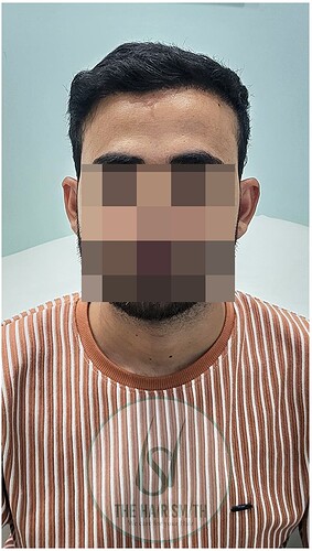 After 11 months hair transplant result update - the hairsmith clinic 1