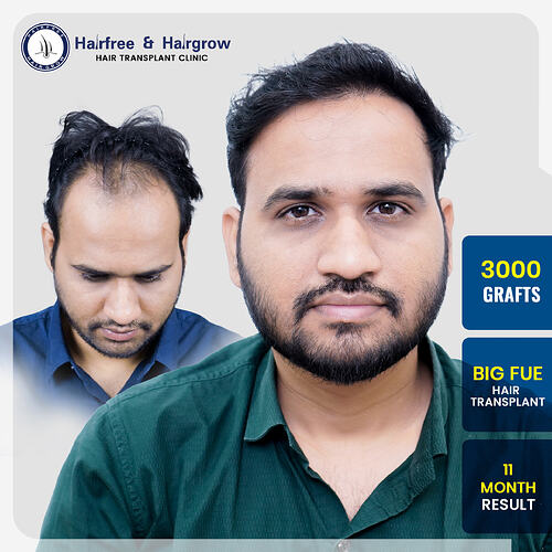dr-arjun-pimple-3000-grafts-big-fue-hair-transplant-11-month-result-pune.jpg