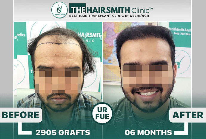 6 months hairsmith hair transplant result - The Hairsmith Clinic - #HairTransplant #The HairmsithClinic
