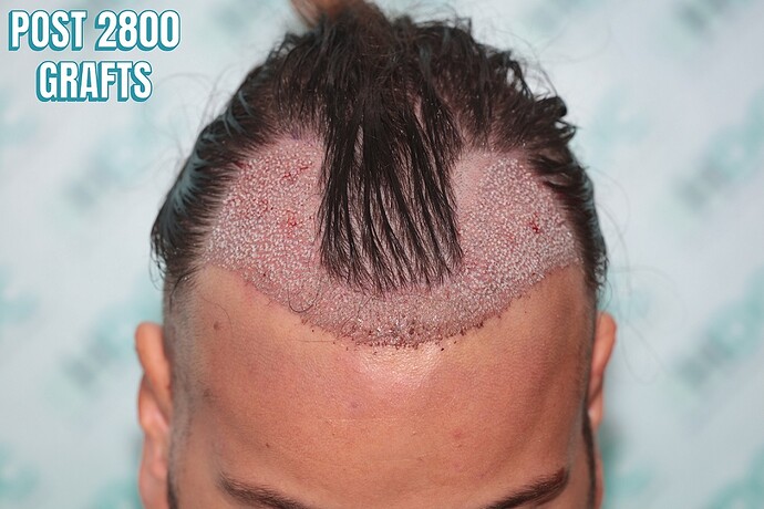 5 FUE1 on 16-03-25 for 2800 Grafts