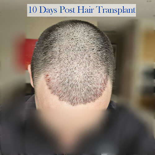 Diamond Hair Clinic in Turkey - Dr. Mehmet Demircioglu - Hair Transplant in Istanbul Turkey - Hair Transplant Patient Conor- 14