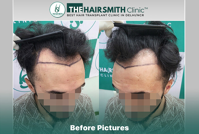Before Hair Transplant HS 844- The Hairsmith Clinic Delhi India - #hairtransplant #hairregrowth