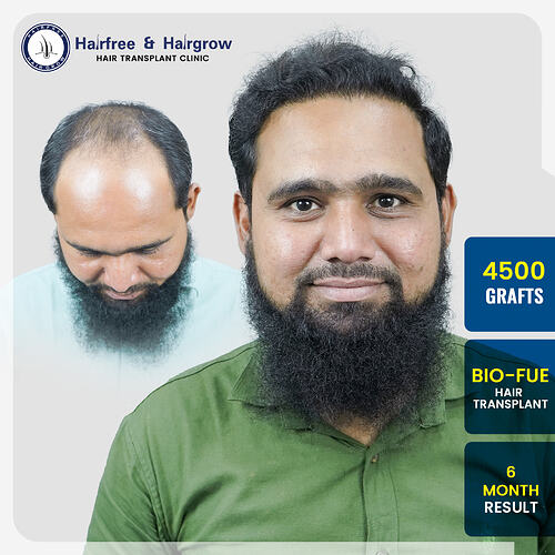 anis-shaikh-4500-grafts-bio-fue-hair-transplant-6-month-result-pune-india.jpg