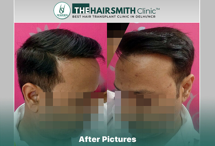 14 months hairsmith hair transplant result - the hairsmith clinic delhi #hairtransplant #thehairsmithclinic