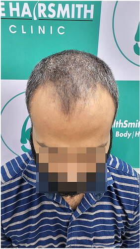 Before Hair Transplant - Norwood Stage 3 - photo 3- The Hairsmith Clinic