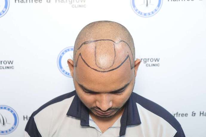 hair line marking