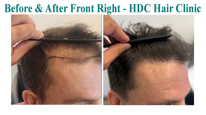 8. Comparison - Right hairline