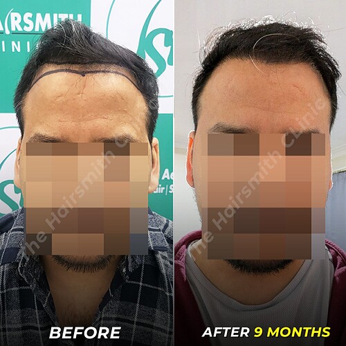 best hair transplant result  after 09 months at the hairsmith clinic