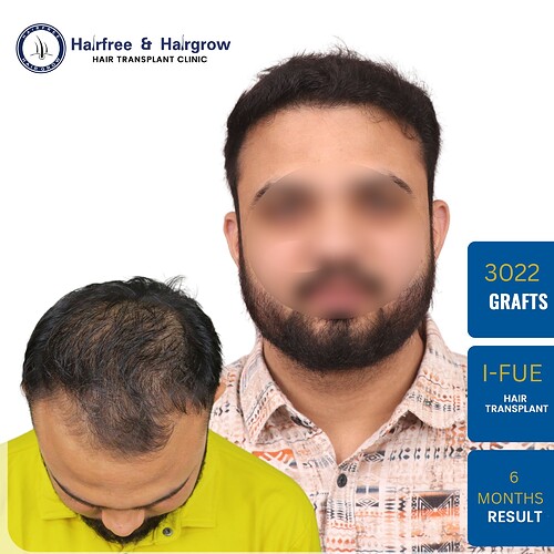 Blur_arwaj-mansuri-3022-grafts-i-fue-6-month-result.jpg