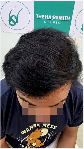 The Hairsmith Hair Transplant Result - After 1 year  Update (2)