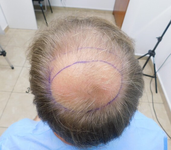 1. Crown and top area before