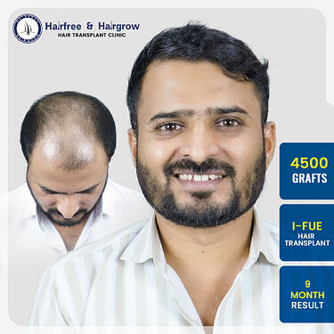 virendra-phadtare-4500-grafts-i-fue-hair-transplant-9-month-result-pune.jpg