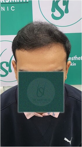 After Hair Transplant Result (2)  in India form The Hairsmith Clinic
