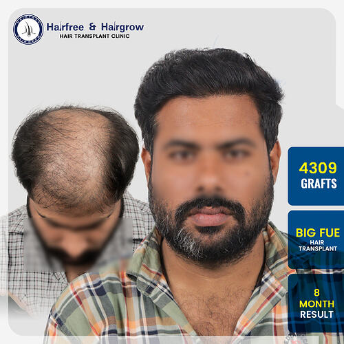 Sanjay Parvani Hair Transplant Result – 4309 Grafts Big FUE  8 Months Pune (1)