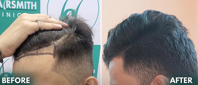 Hair Transplant Result - After 06 Months Update 5 - The Hairsmith Clinic