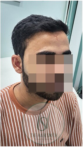 After 11 months hair transplant result update - the hairsmith clinic 3