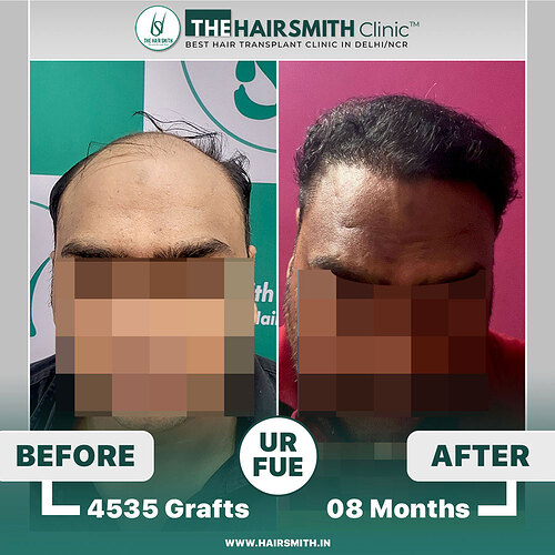 The Hairsmith Clinic Hair Transplant Result - Before and after result 1
