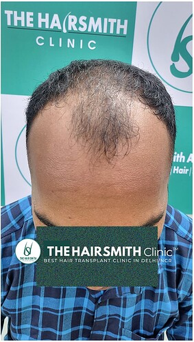 Before Hair Transplant Picture 2 - The Hairsmith Clinic