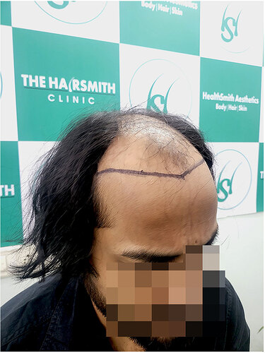 Before Hair Transplant HS 829- The Hairsmith Clinic Delhi India 3
