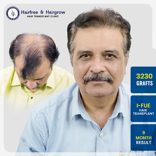 atik-panchal-3230-grafts-i-fue-hair-transplant-9-month-result-pune.jpg