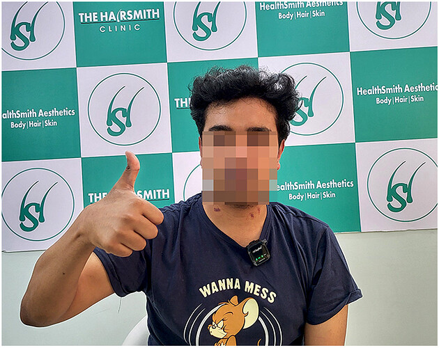 The Hairsmith Hair Transplant Re Uploading: Amazing hair transplant result cp 1 - the hairsmith clinic.jpg… sult - After 1 year  Update (1)
