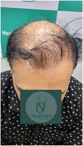 Patient Norwood stages 7 - Before  Picture 2 - The Hairsmith Hair Transplant Clinic