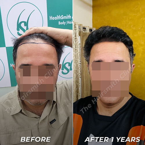 Hair Transplant Result - After 1 Years Update - The Hairsmith Clinic