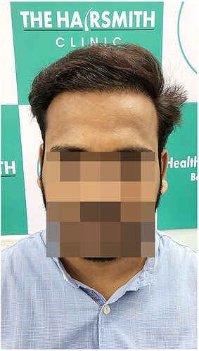 After Hair Transplant Result - The Hairsmith Clinic (1)