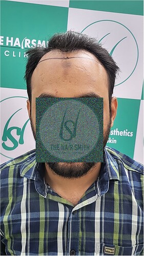 Patient Norwood stages 3 - Before  Picture (1) - The Hairsmith Hair Transplant Clinic